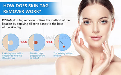 3 In 1 Painless Skin Tag Removal Kit - Smarsty