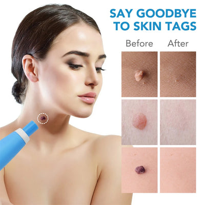 2 In 1 Painless Skin Tag Removal Kit for Face and Body - Smarsty
