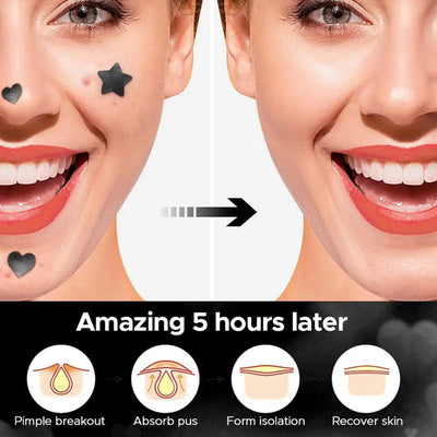 Colorful Star Acne Patches for Spot Treatment - Smarsty
