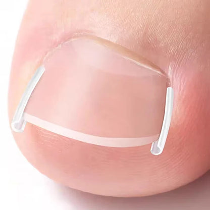 50Pcs Ingrown Toenail Correction Pads for Pain Relief - Smarsty