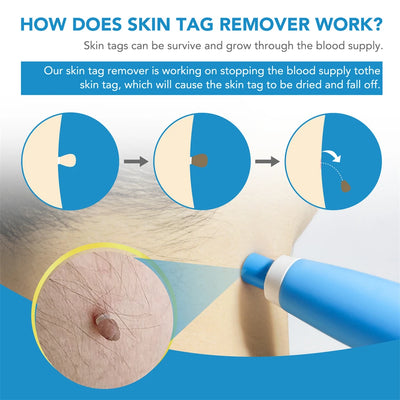 2 In 1 Painless Skin Tag Removal Kit for Face and Body - Smarsty