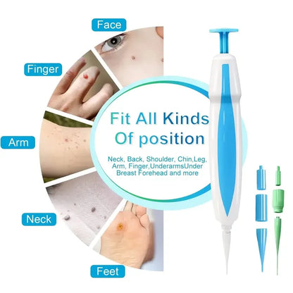 3 In 1 Painless Skin Tag Removal Kit - Smarsty
