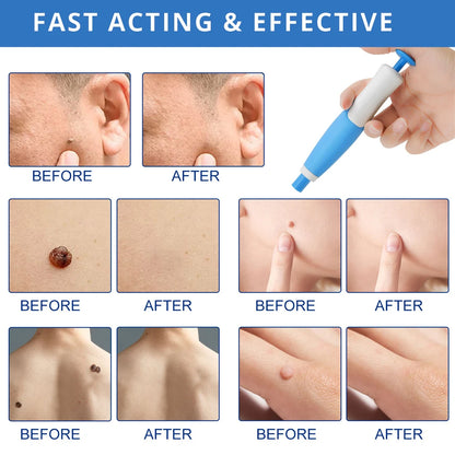 2 in 1 Skin Tag Remover Kit for Effective Face Care - Smarsty