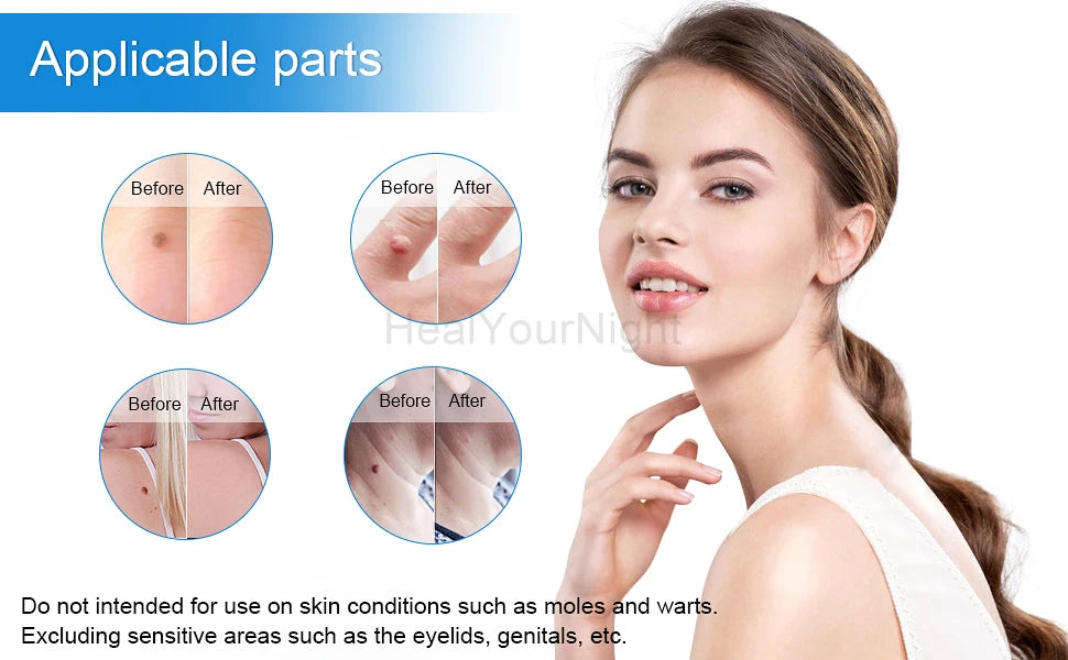 3 In 1 Painless Skin Tag Removal Kit - Smarsty