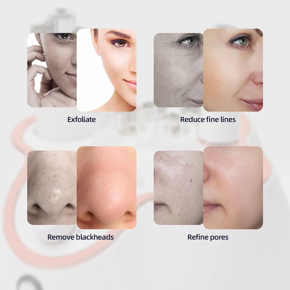 Professional Diamond Microdermabrasion Machine for Home Use - Smarsty