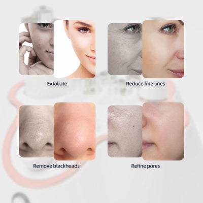 Professional Diamond Microdermabrasion Machine for Home Use - Smarsty