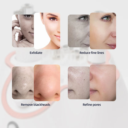 Professional Diamond Microdermabrasion Machine for Home Use - Smarsty