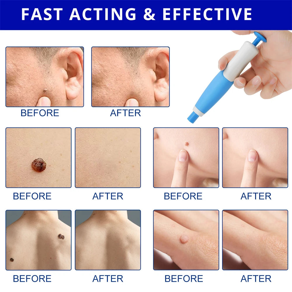 2 In 1 Painless Skin Tag Removal Kit for Face and Body - Smarsty