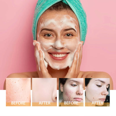 Turmeric Cleanser Face Wash Kojic Acid Exfoliating Deeply Cleanses Skin Maintains Water Oil Balance Remove Dirt Oil Control