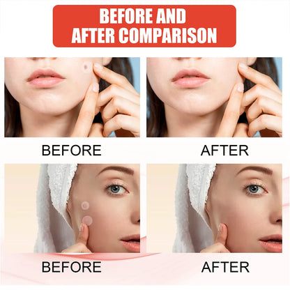 240pcs Star Acne Patches For Effective Spot Treatment - Smarsty