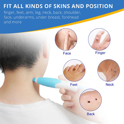 2 In 1 Painless Skin Tag Removal Kit for Face and Body - Smarsty