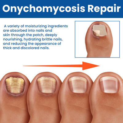 Nail Repair Patches for Toenail Fungus Relief - Smarsty