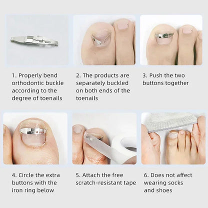 Ingrown Toenail Correction Tool for Effective Foot Care - Smarsty