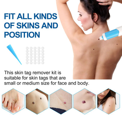 3 In 1 Painless Skin Tag Removal Kit - Smarsty
