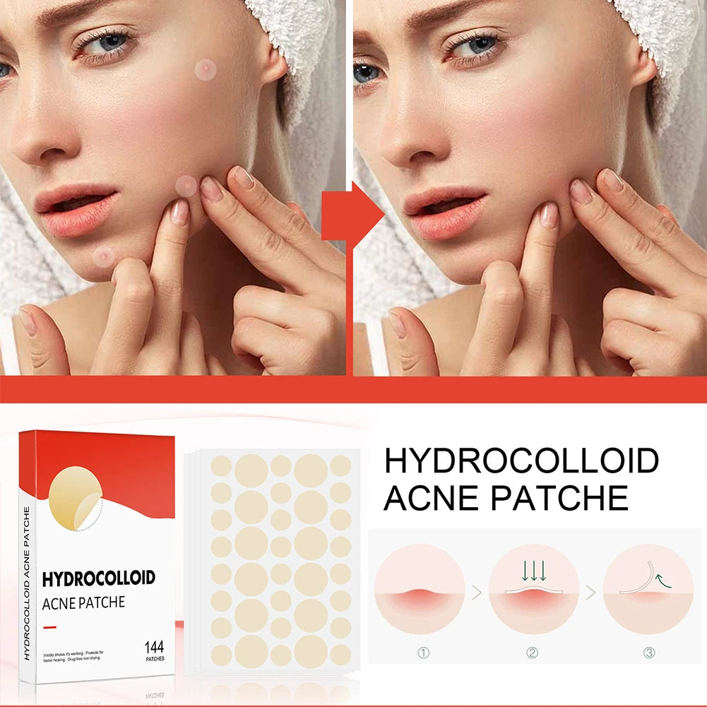 144 Piece Acne Pimple Patch Set for Clear Skin - Smarsty