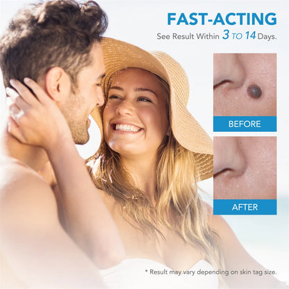 2 In 1 Painless Skin Tag Removal Kit for Face and Body - Smarsty