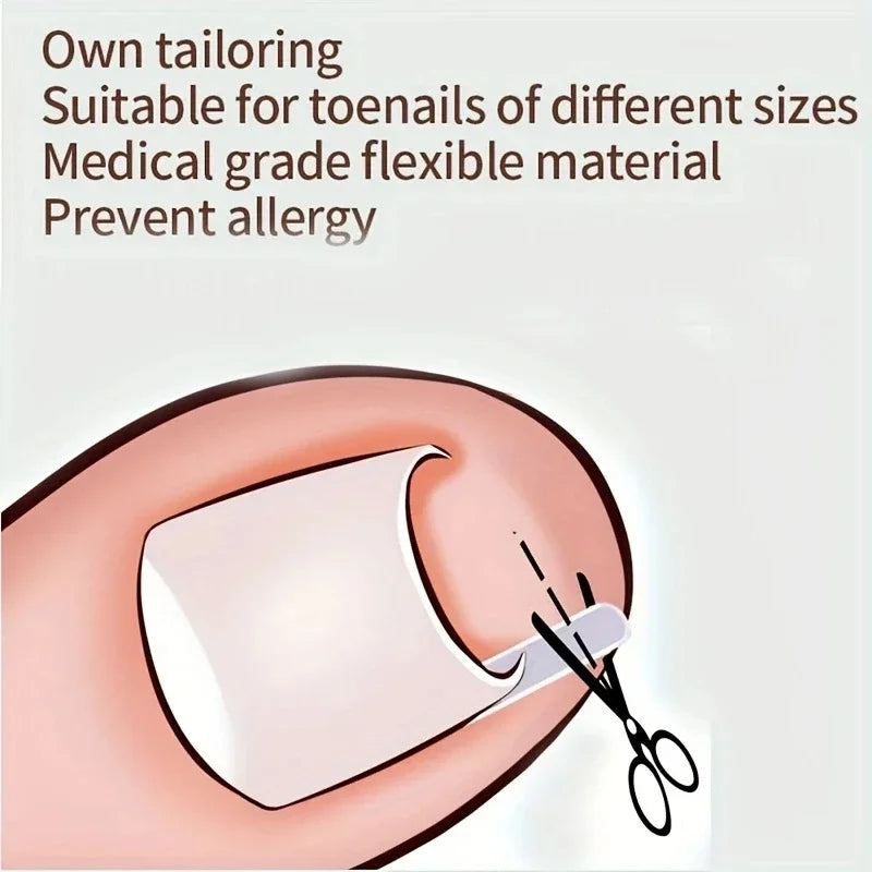 50Pcs Ingrown Toenail Correction Pads for Pain Relief - Smarsty