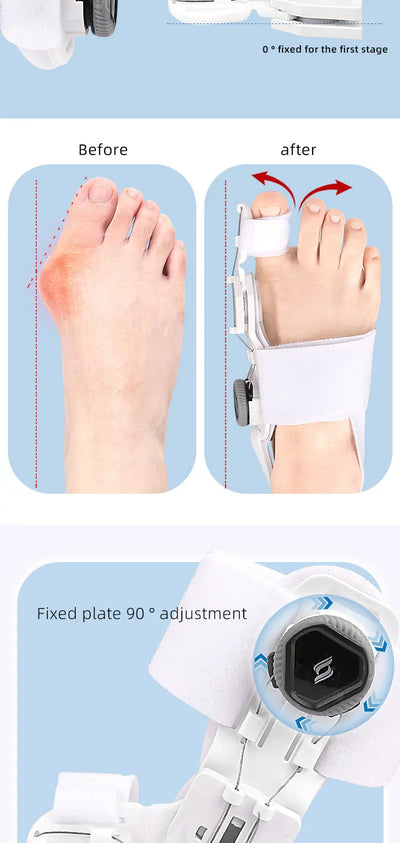 Bunion Corrector Adjustable Rotatable Toe Separator - Smarsty