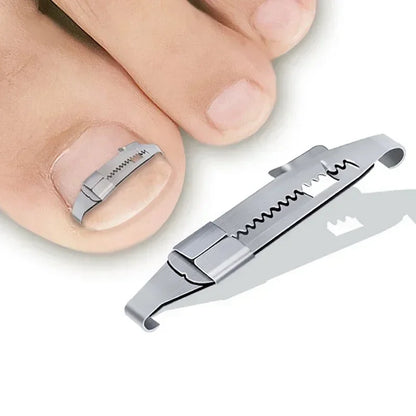 Ingrown Toenail Correction Tool for Effective Foot Care - Smarsty