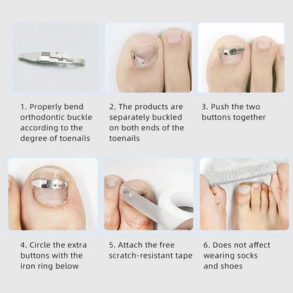 Ingrown Toenail Correction Tool for Effective Foot Care - Smarsty