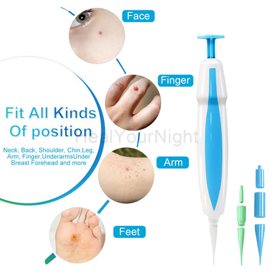 3 In 1 Painless Skin Tag Removal Kit - Smarsty
