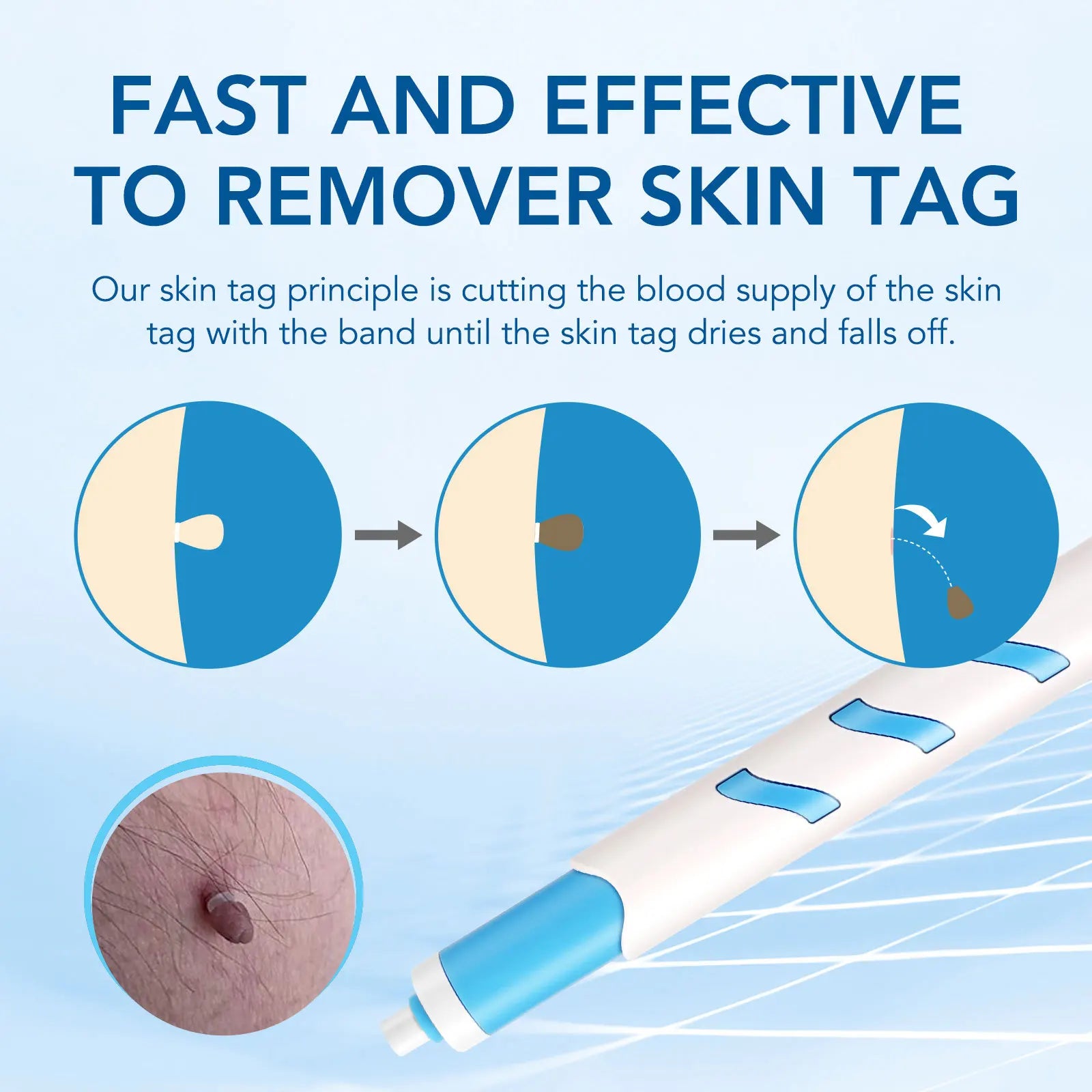 3 In 1 Painless Skin Tag Removal Kit - Smarsty