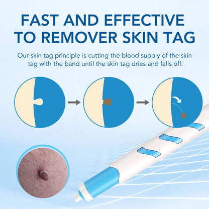 3 In 1 Painless Skin Tag Removal Kit - Smarsty
