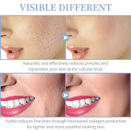 Handheld Electric Facial Therapy Wand for Acne Treatment - Smarsty