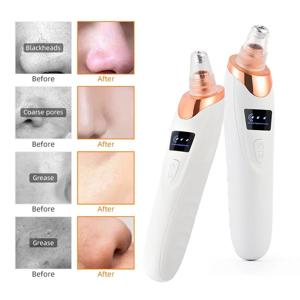 Vacuum Blackhead Remover With USB Charging Convenience - Smarsty