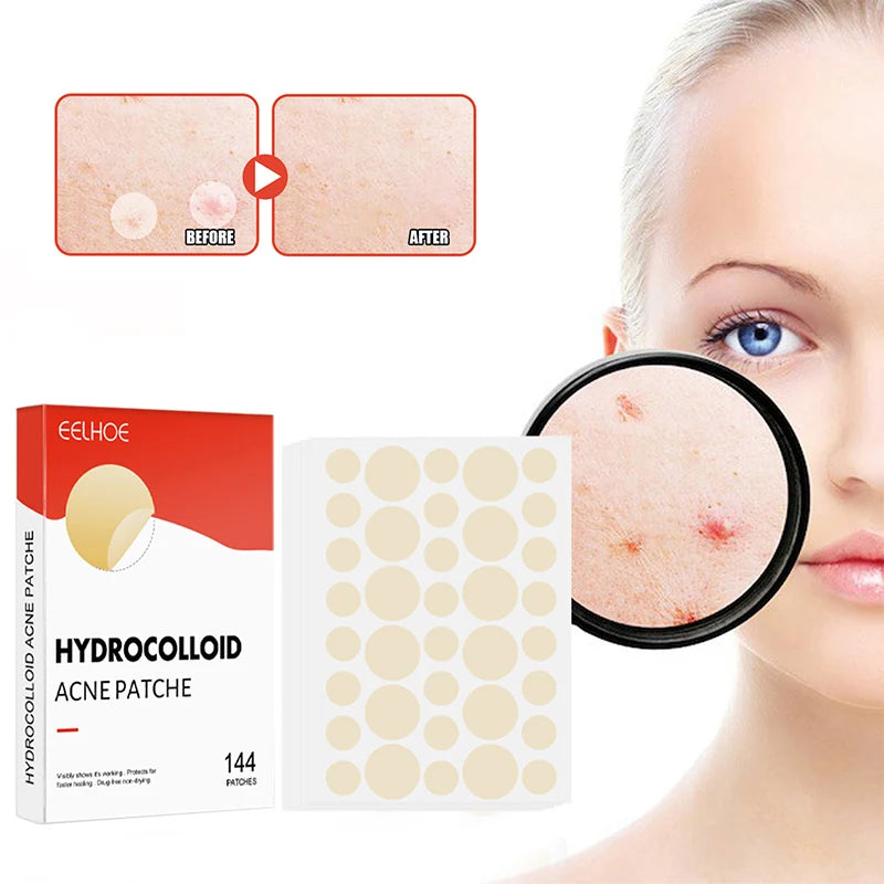 144 Piece Acne Pimple Patch Set for Clear Skin - Smarsty