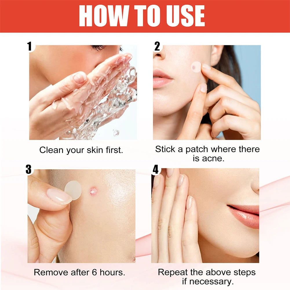 144 Piece Acne Pimple Patch Set for Clear Skin - Smarsty
