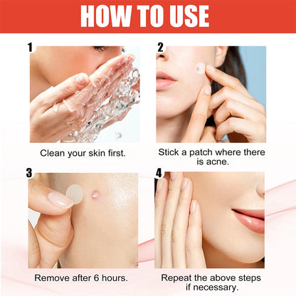 144 Piece Acne Pimple Patch Set for Clear Skin - Smarsty