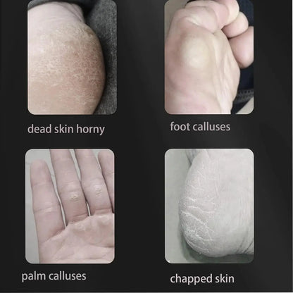 8 Piece Foot Exfoliating Rasp Set for Smooth Heels - Smarsty
