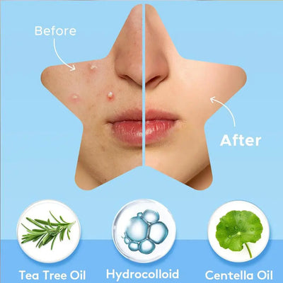 Colorful Star Acne Patches for Spot Treatment - Smarsty