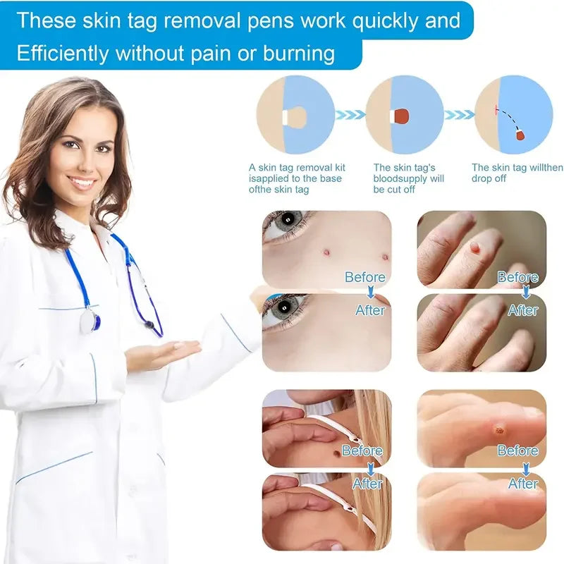 3 In 1 Painless Skin Tag Removal Kit - Smarsty