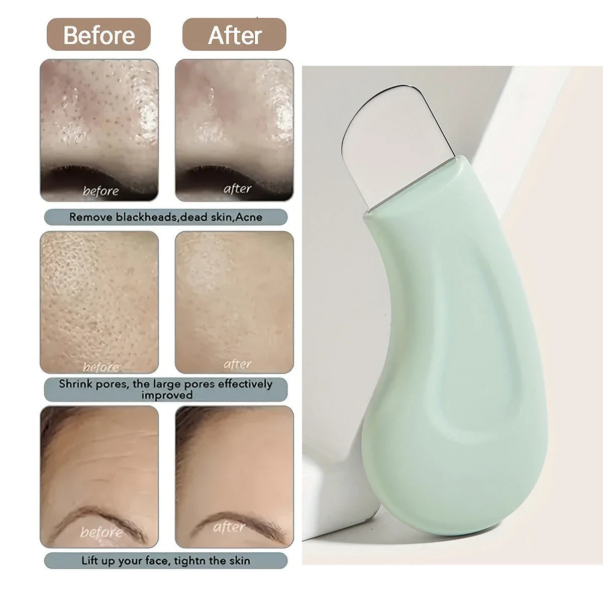 Blackhead and Whitehead Removal Tool for Clear Skin - Smarsty