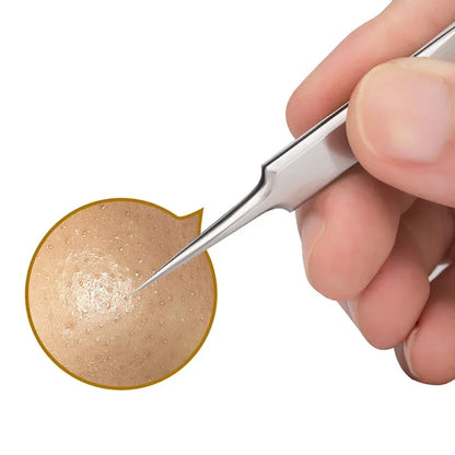 German Ultra Fine Blackhead Remover Tool for Clear Skin - Smarsty