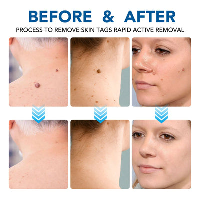 3 In 1 Painless Skin Tag Removal Kit - Smarsty