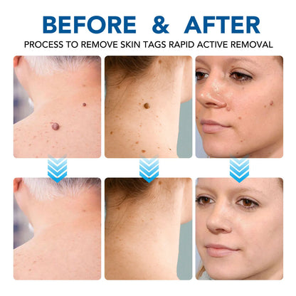 3 In 1 Painless Skin Tag Removal Kit - Smarsty