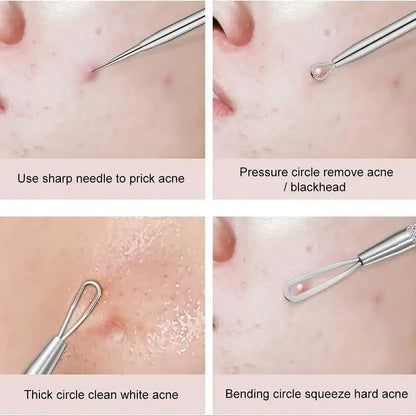4 Piece Acne Blackhead Removal Needle Set - Smarsty