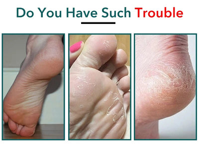 Professional Stainless Steel Callus Remover for Smooth Heels - Smarsty