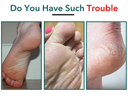 Professional Stainless Steel Callus Remover for Smooth Heels - Smarsty