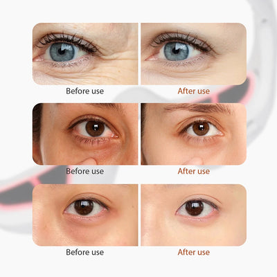 Electric Eye Massager for Dark Circles and Eye Bags - Smarsty