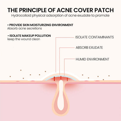 240 pieces of multi-color star acne patches, facial acne patches, concealer acne patches, and pimples patches, ultra-thin - Smarsty