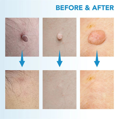 2 In 1 Painless Skin Tag Removal Kit for Face and Body - Smarsty
