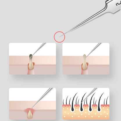 German Ultra Fine Tweezers for Blackhead Removal - Smarsty